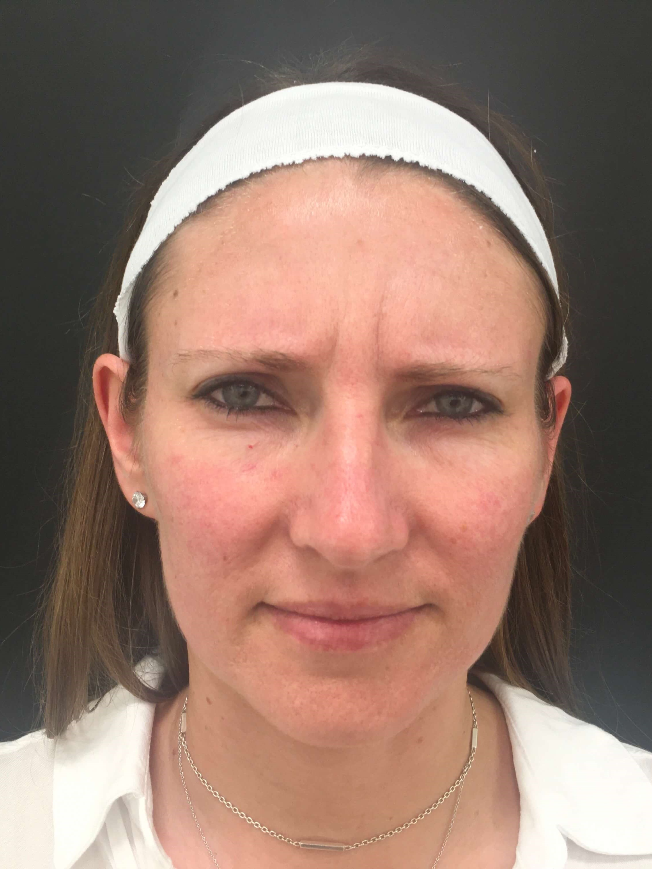 Xeomin treatment for the 11s Before