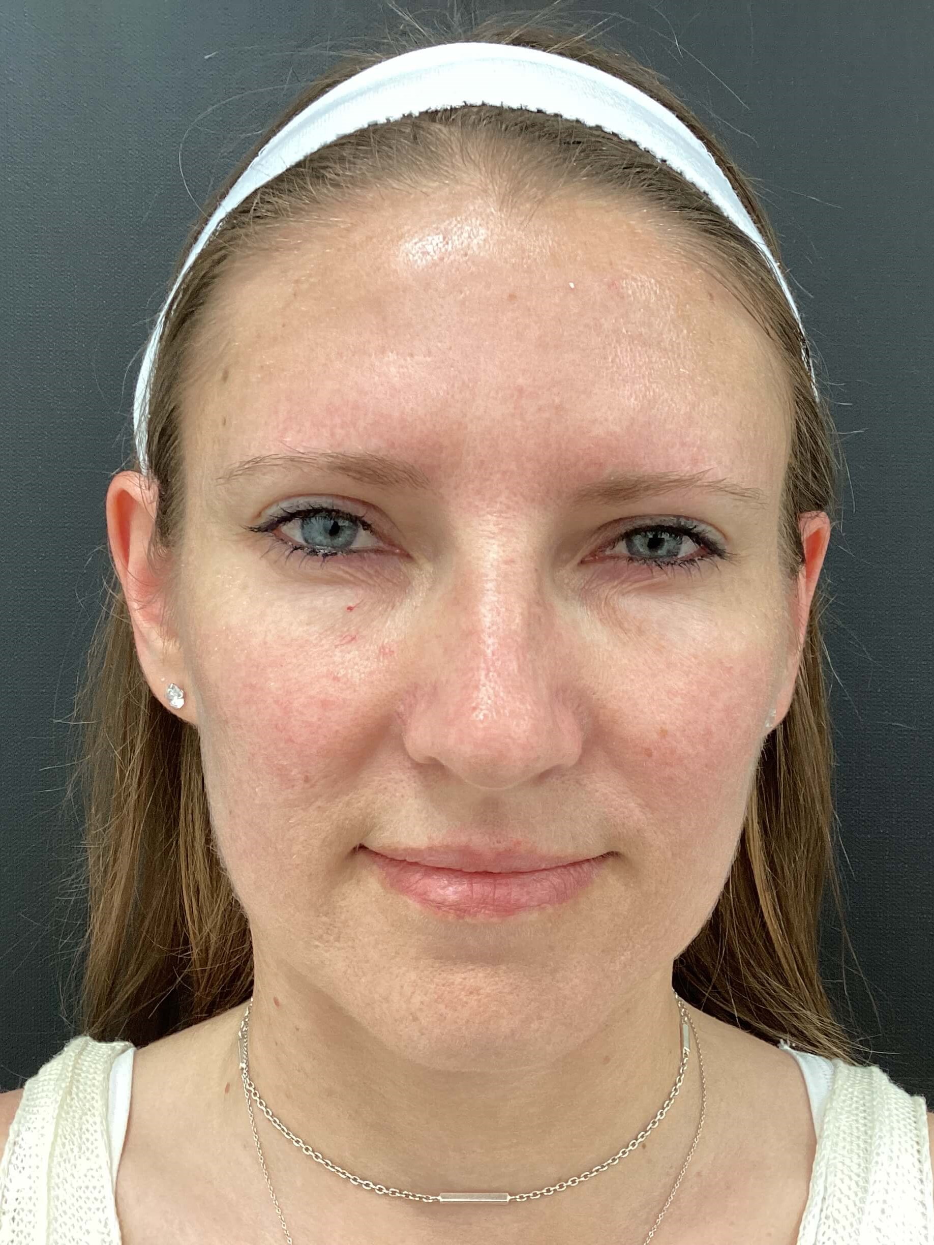 Xeomin treatment for the 11s After