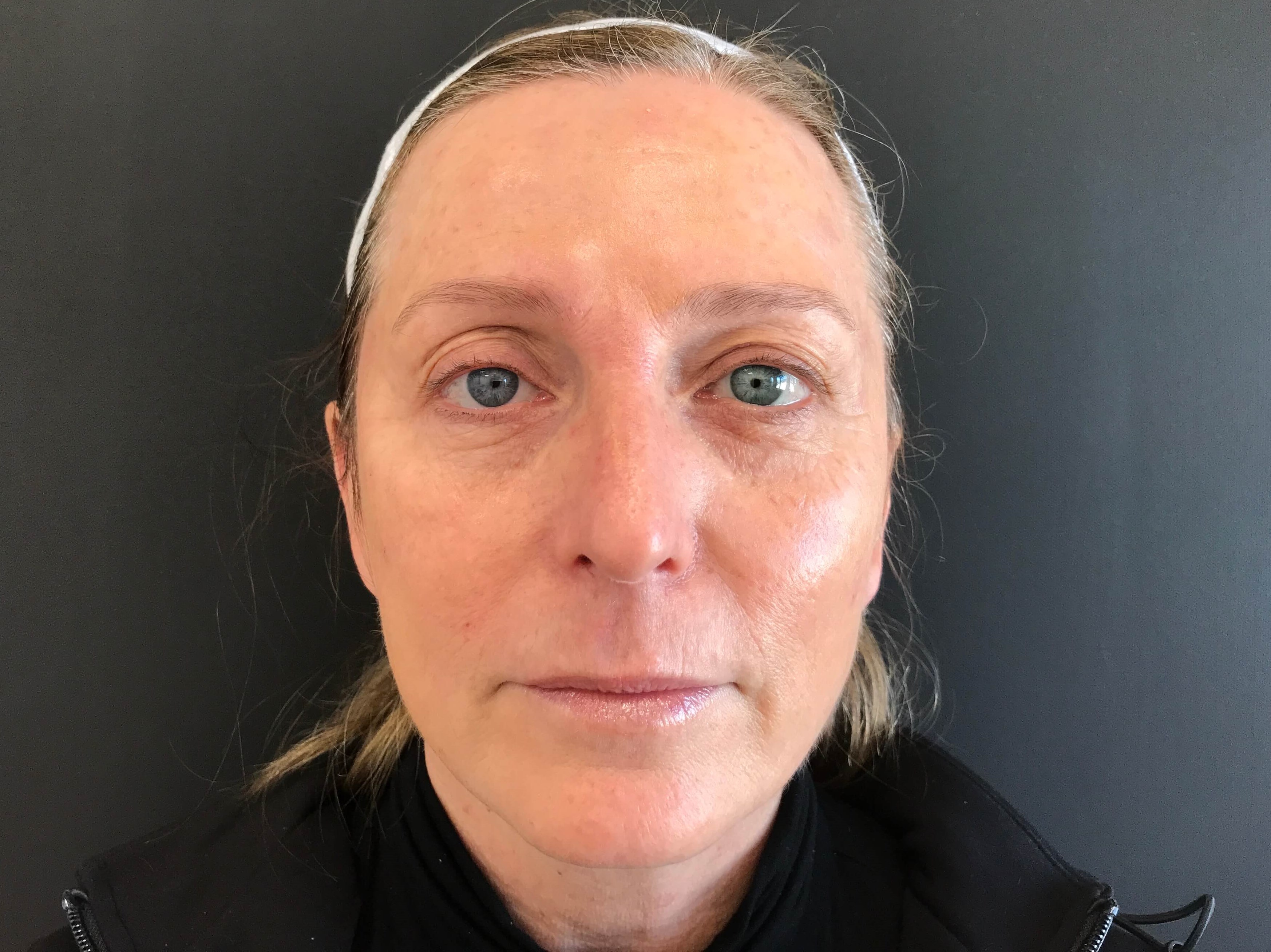 Sculptra before and after Immediately After Treatment