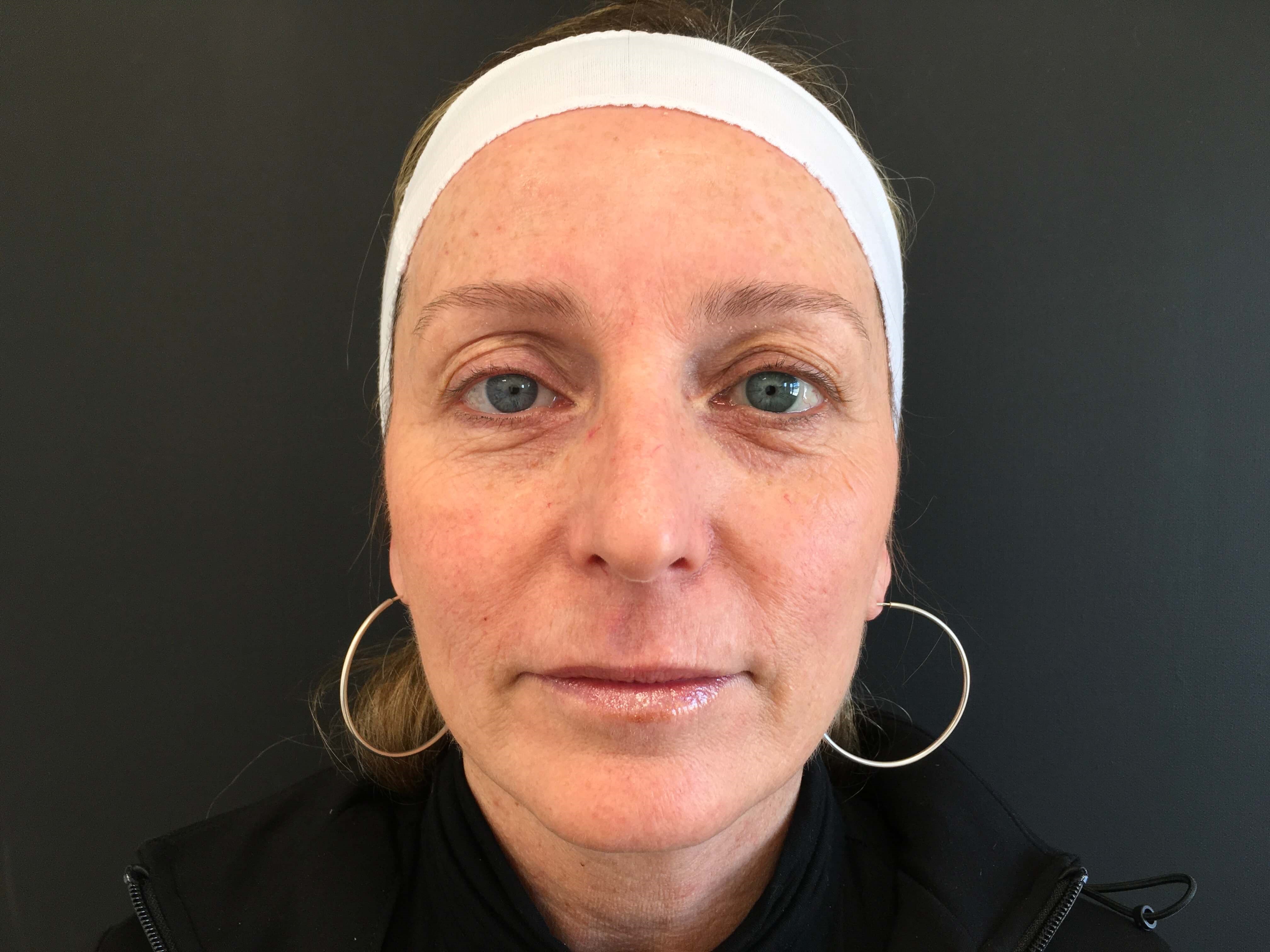 Sculptra before and after Before Treatment