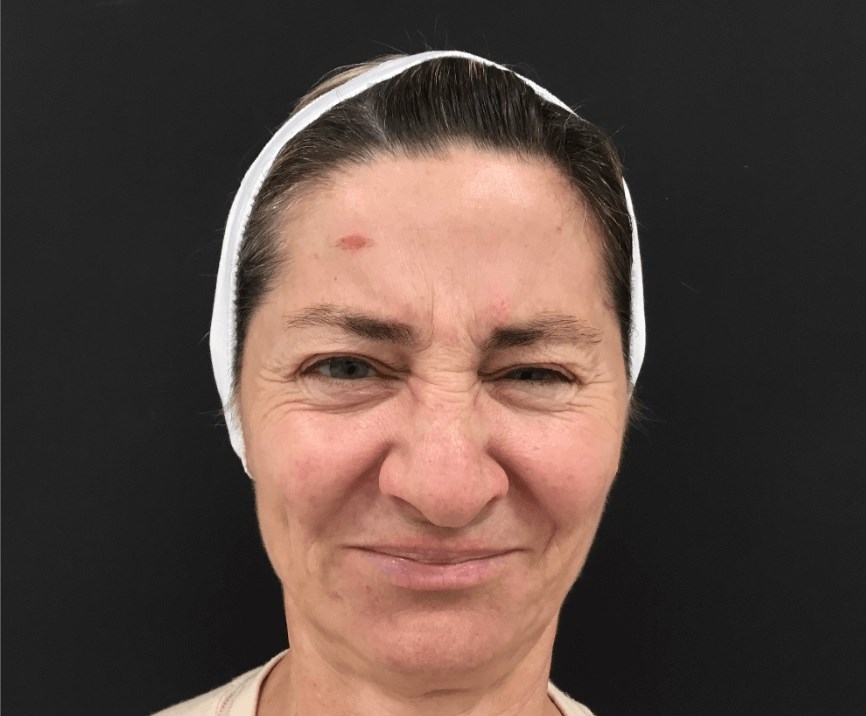 Botox and filler results Before