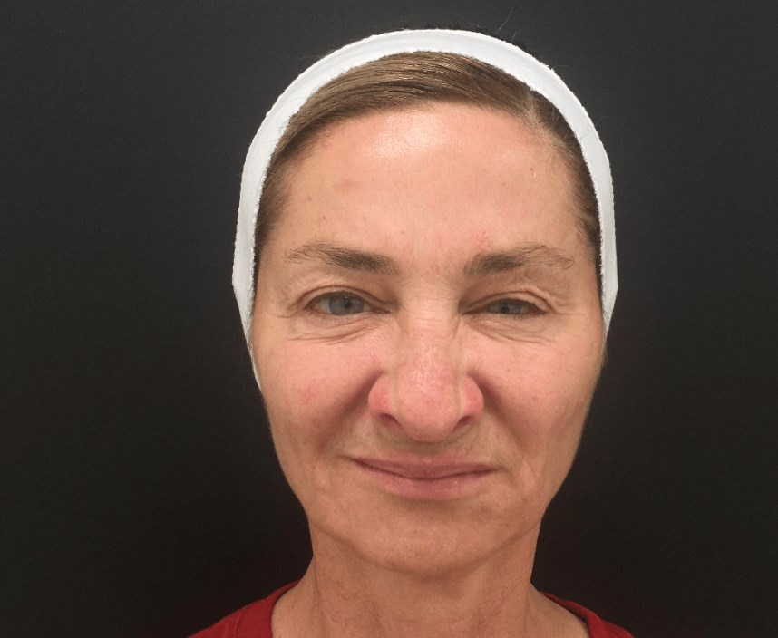 Botox and filler results After