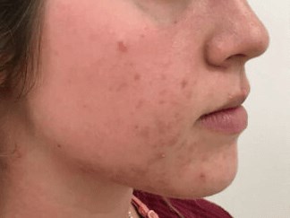 Acne management Before