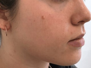 Acne management After