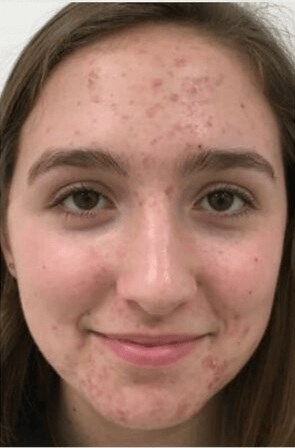 Acne treatment and scarring Before