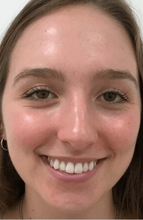 Acne treatment and scarring After