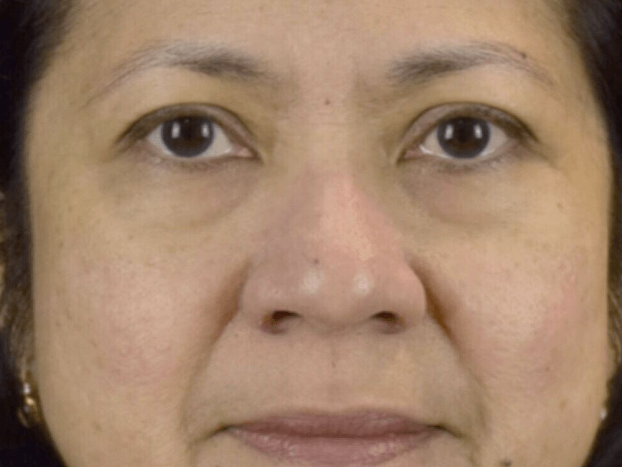 PDO Thread for smile lines Before