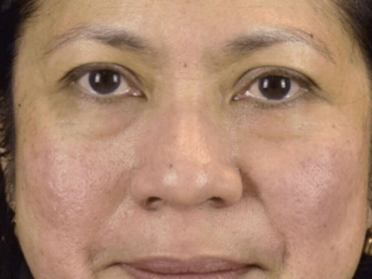 PDO Thread for smile lines After