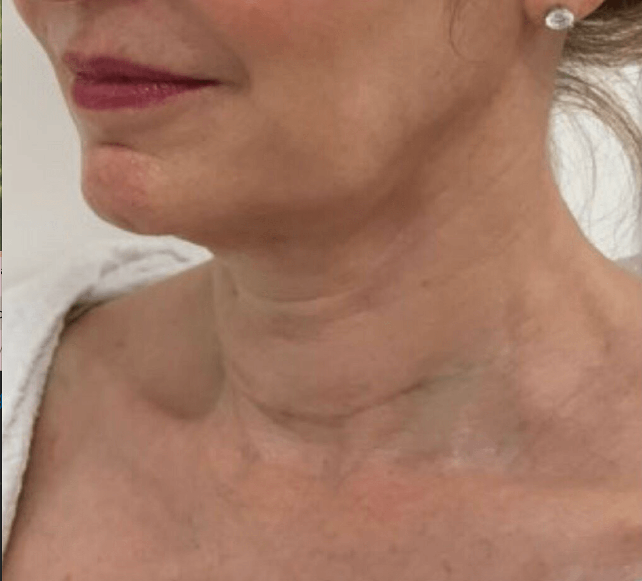 PDO Thread Lift, side profile Before