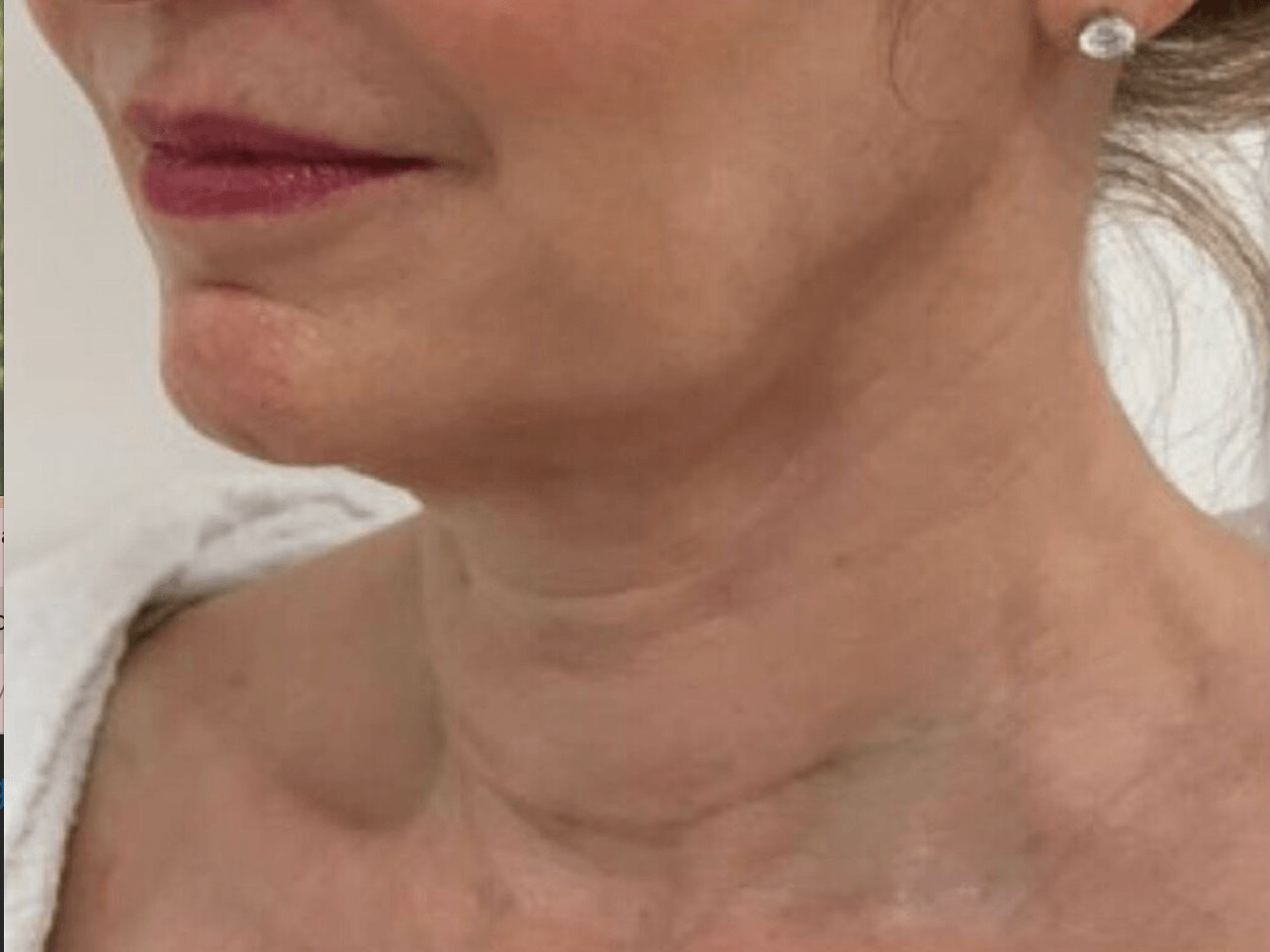 PDO Thread Lift, side profile Before