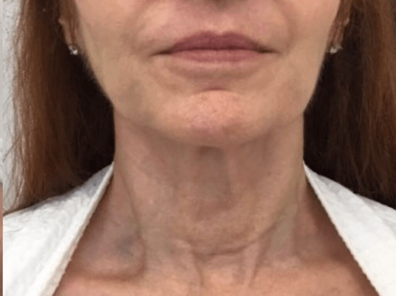 Refreshing PDO Thread Lift After