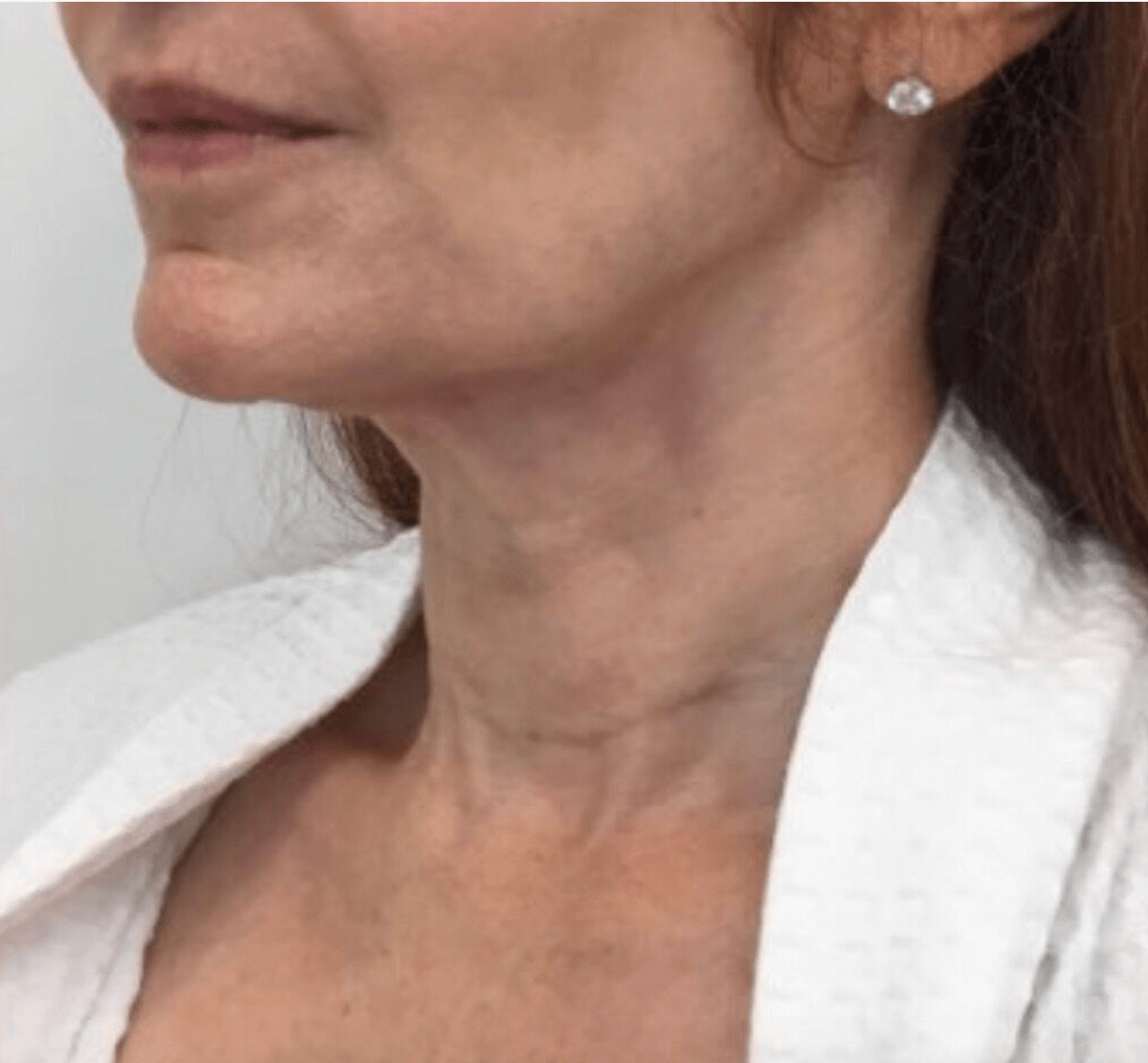 PDO Thread Lift, side profile After