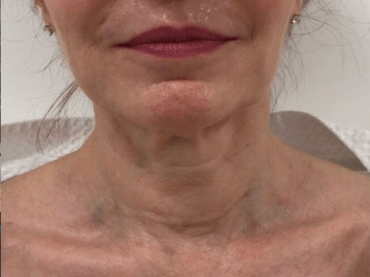 Refreshing PDO Thread Lift Before