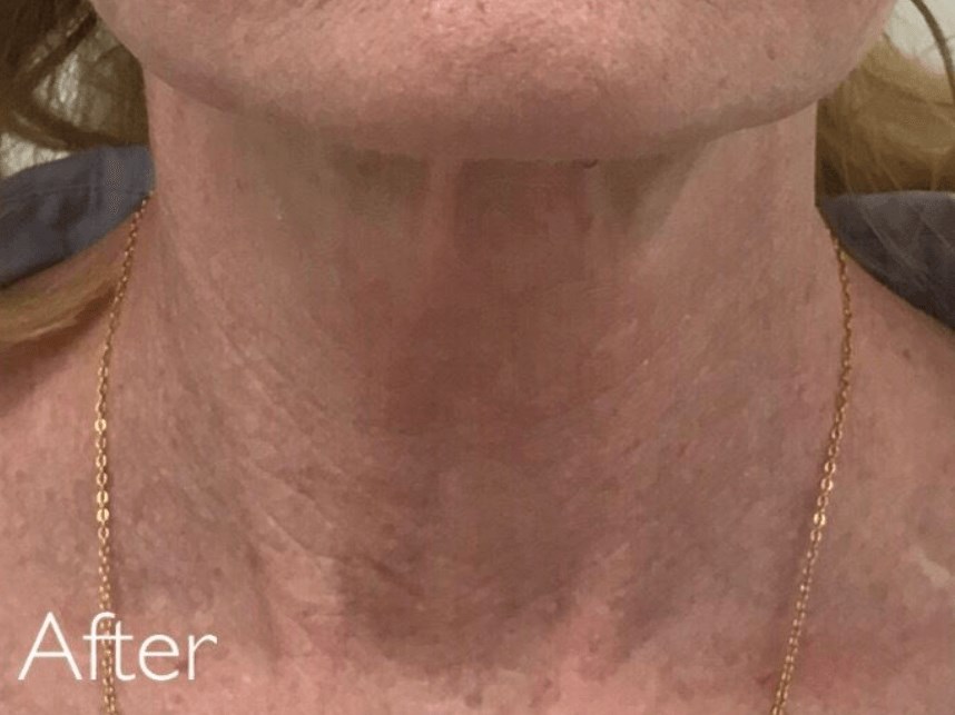 PDO Thread Lift, neck After