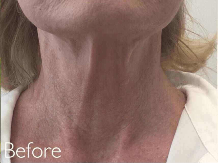 PDO Thread Lift, neck Before