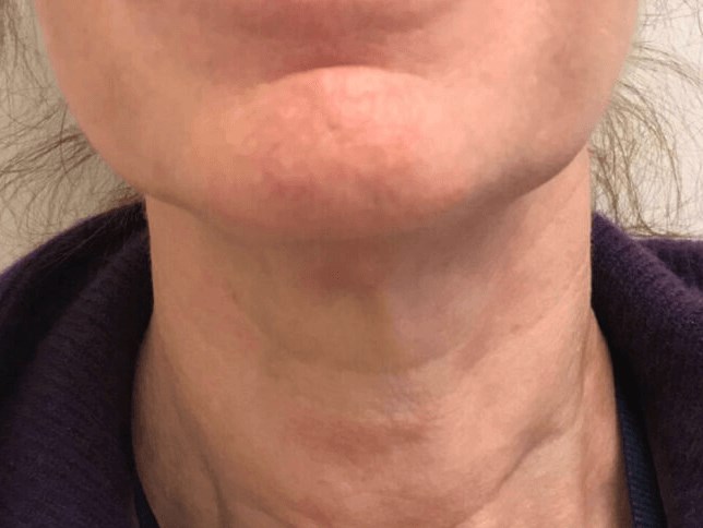 PDO Thread, Neck Lift After