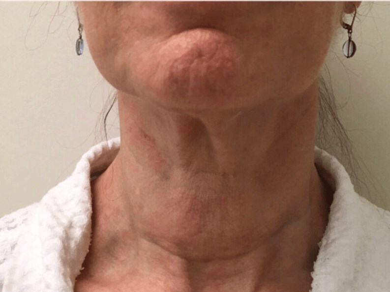 PDO Thread, Neck Lift Before