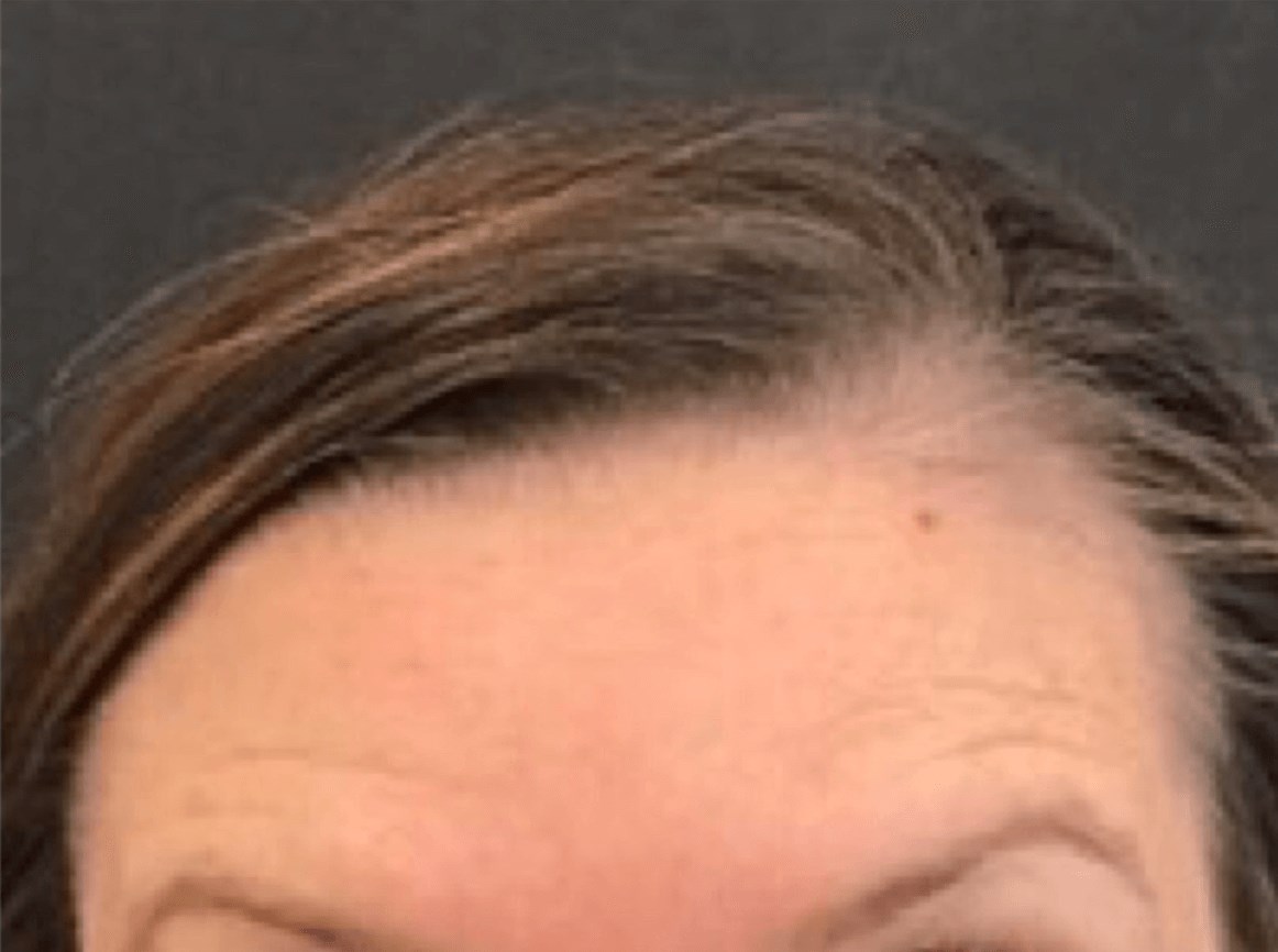 Forehead Botox After