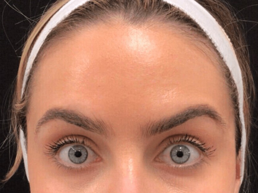 Forehead Botox After