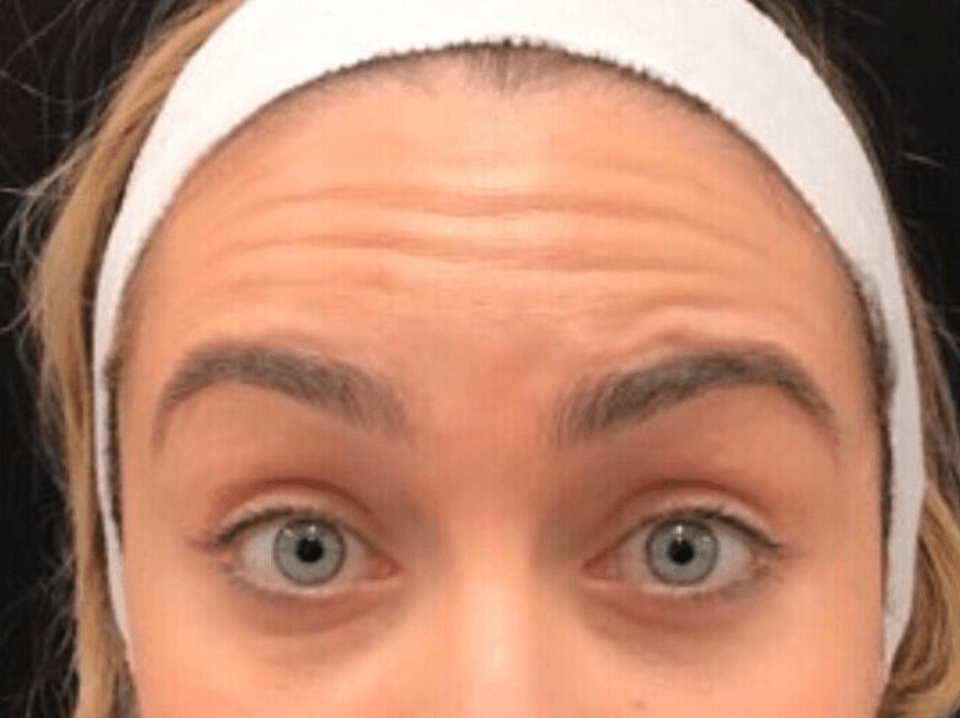 Forehead Botox Before