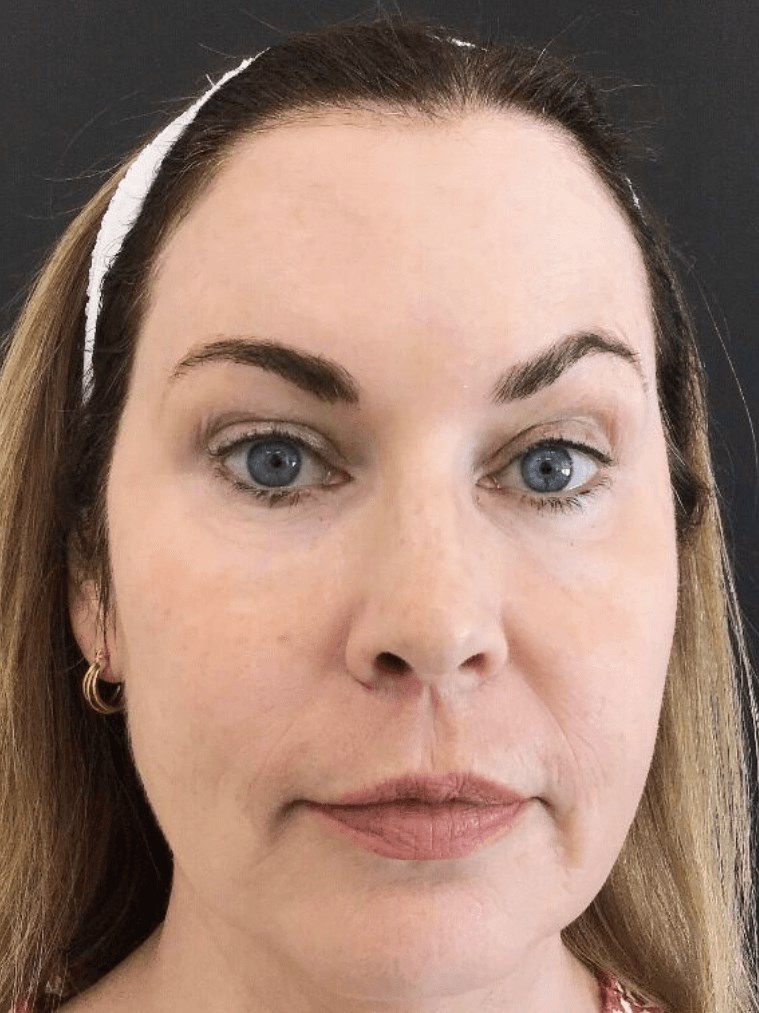 Forehead Botox After