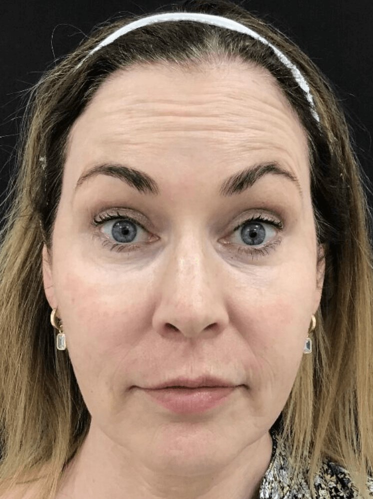 Forehead Botox Before