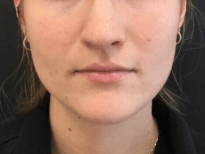 Botox For Facial Slimming Before