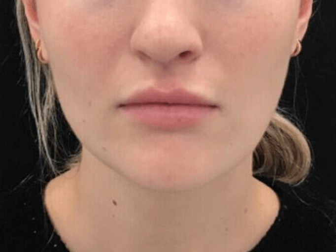 Botox For Facial Slimming After