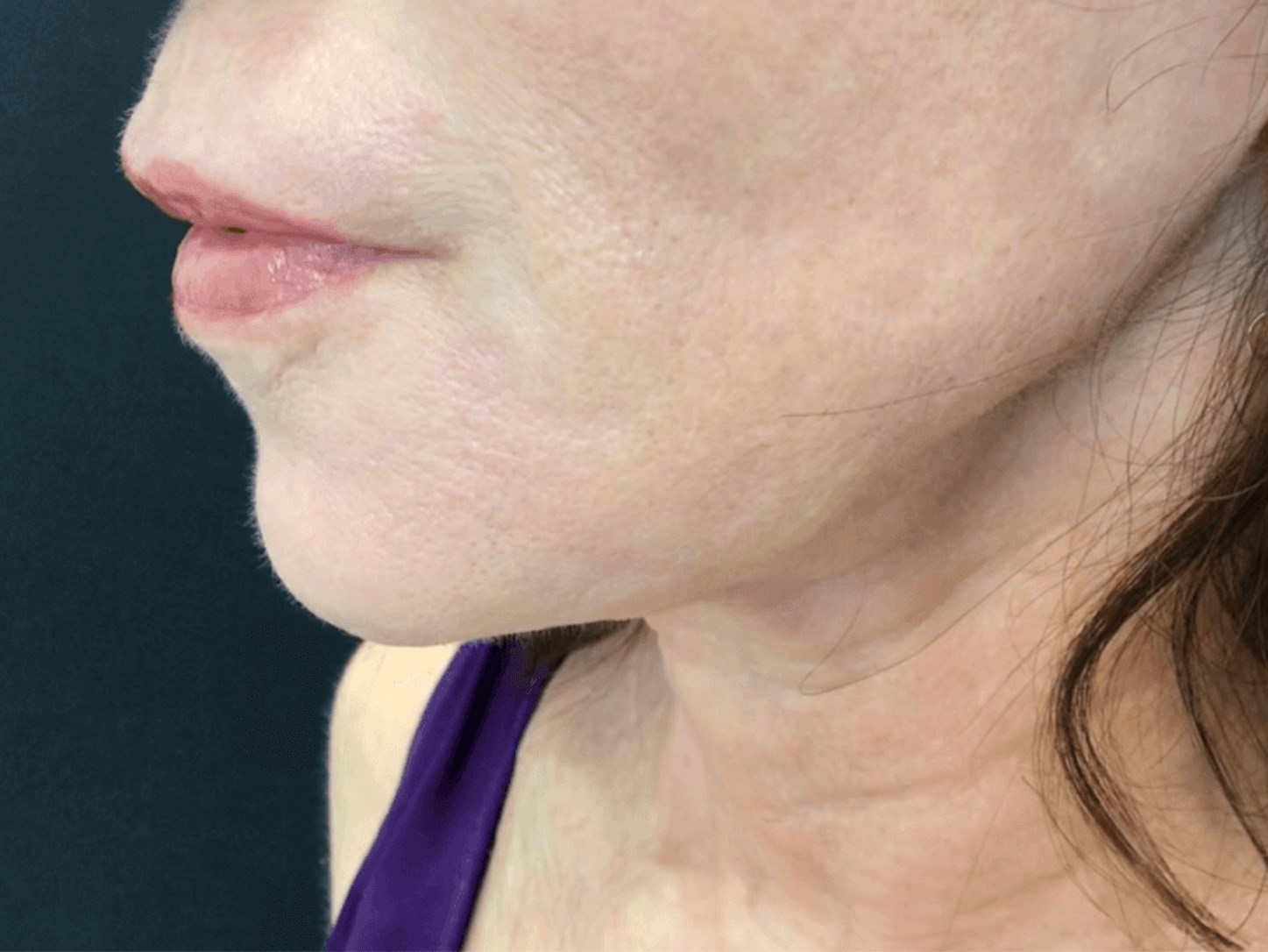 Refreshing PDO Thread Lift After