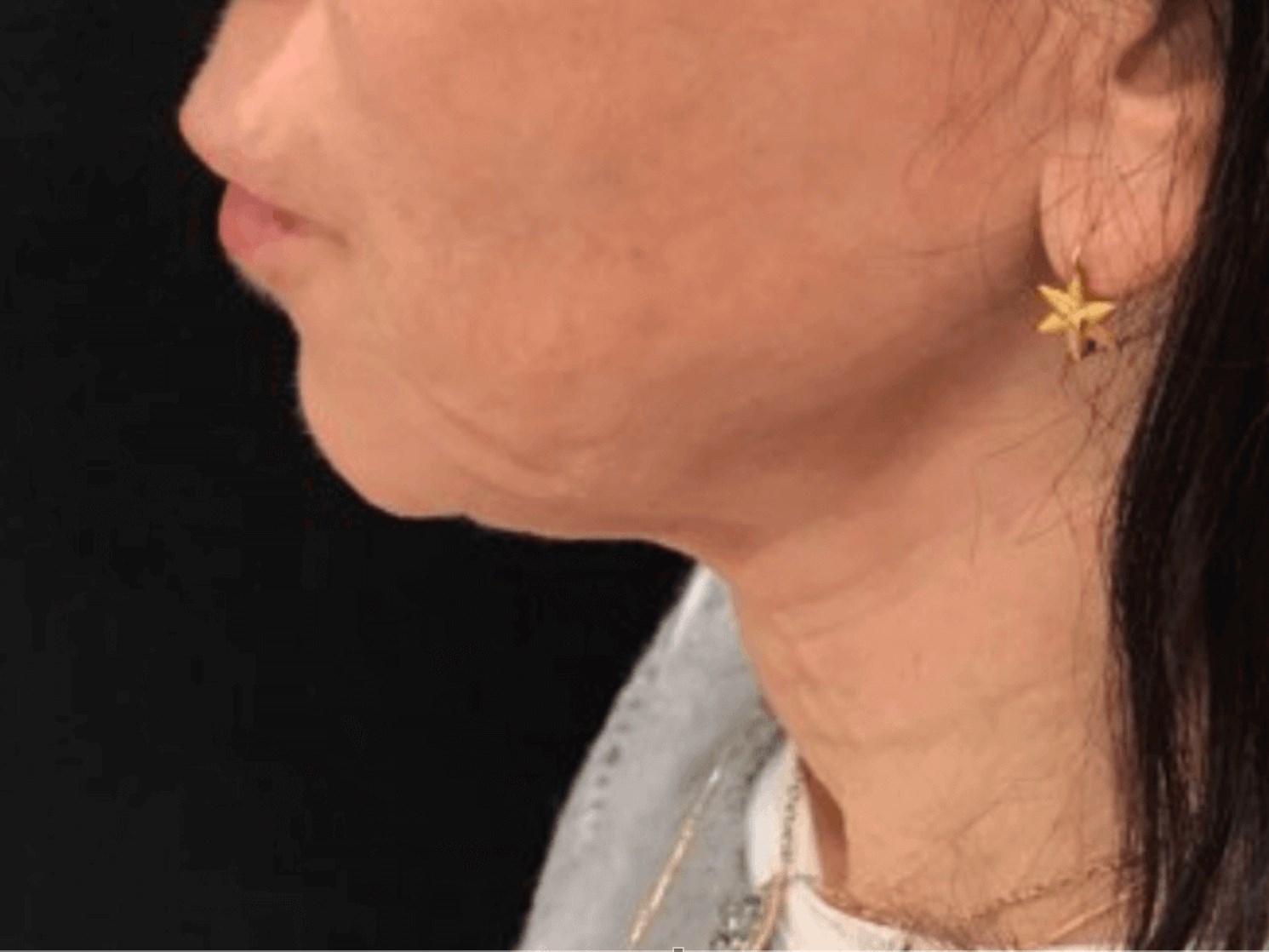 Refreshing PDO Thread Lift Before