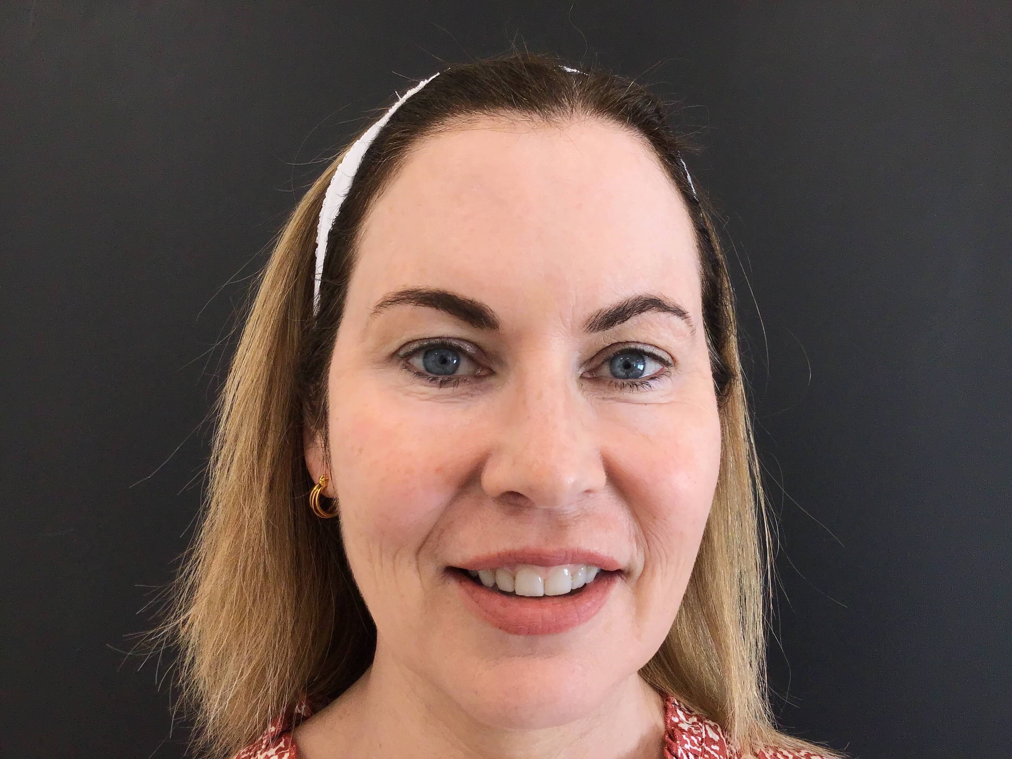 Xeomin for crows feet After