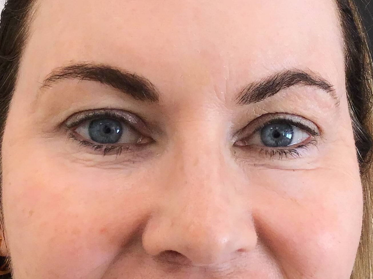 Xeomin for crows feet After