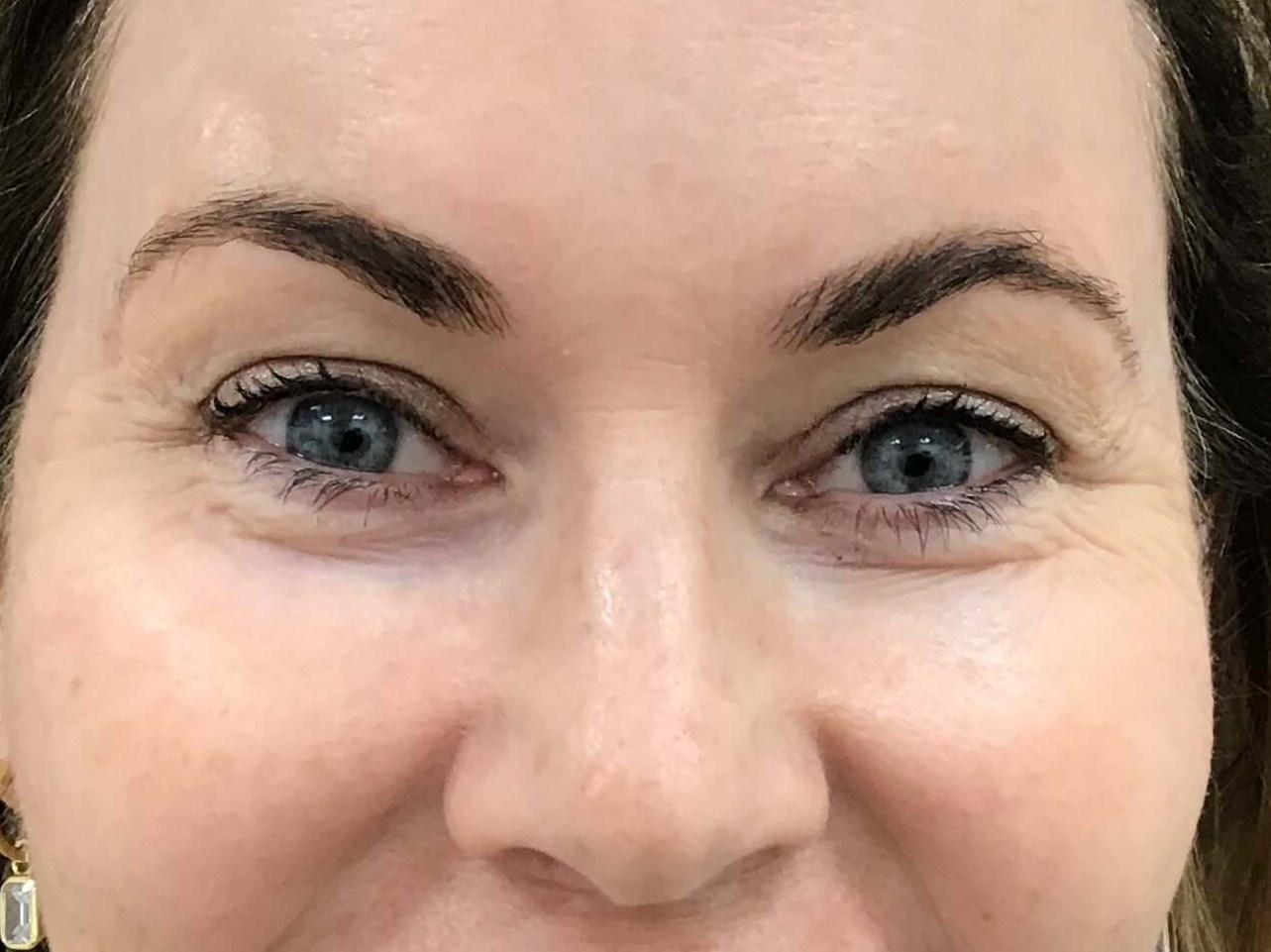 Xeomin for crows feet Before