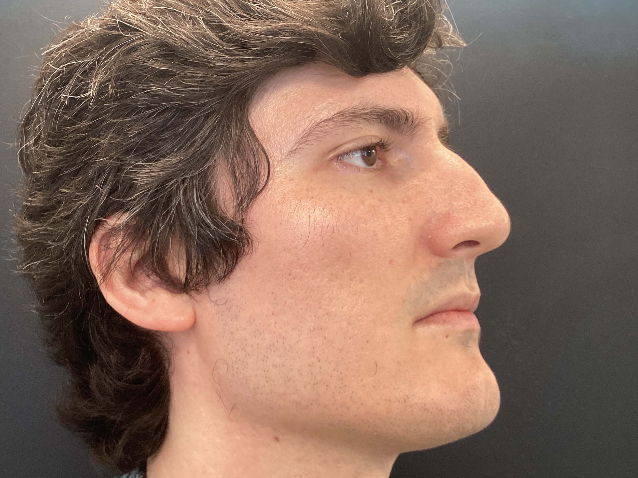 Juvederm Volux for jawline After