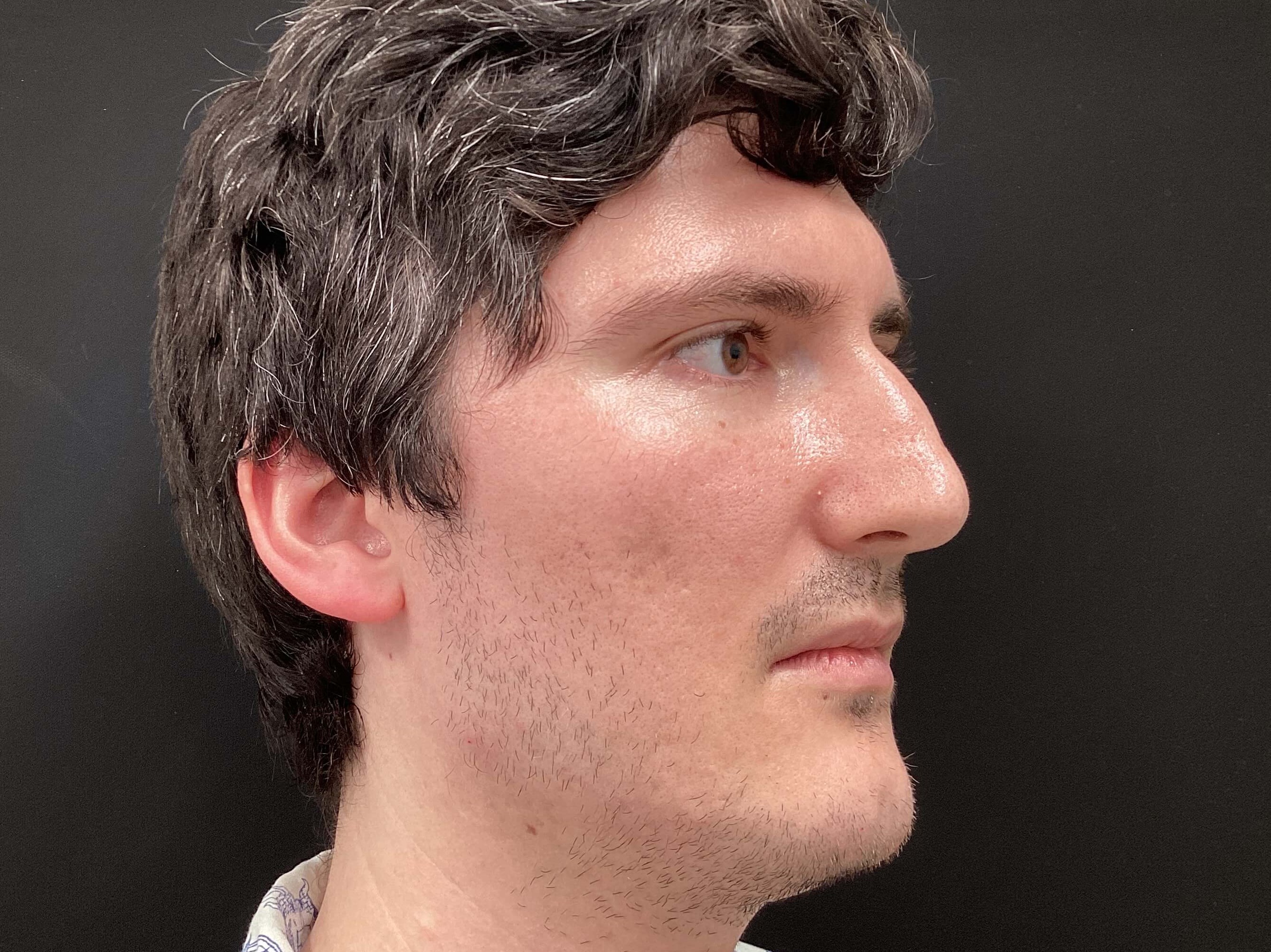 Juvederm Volux for jawline Before