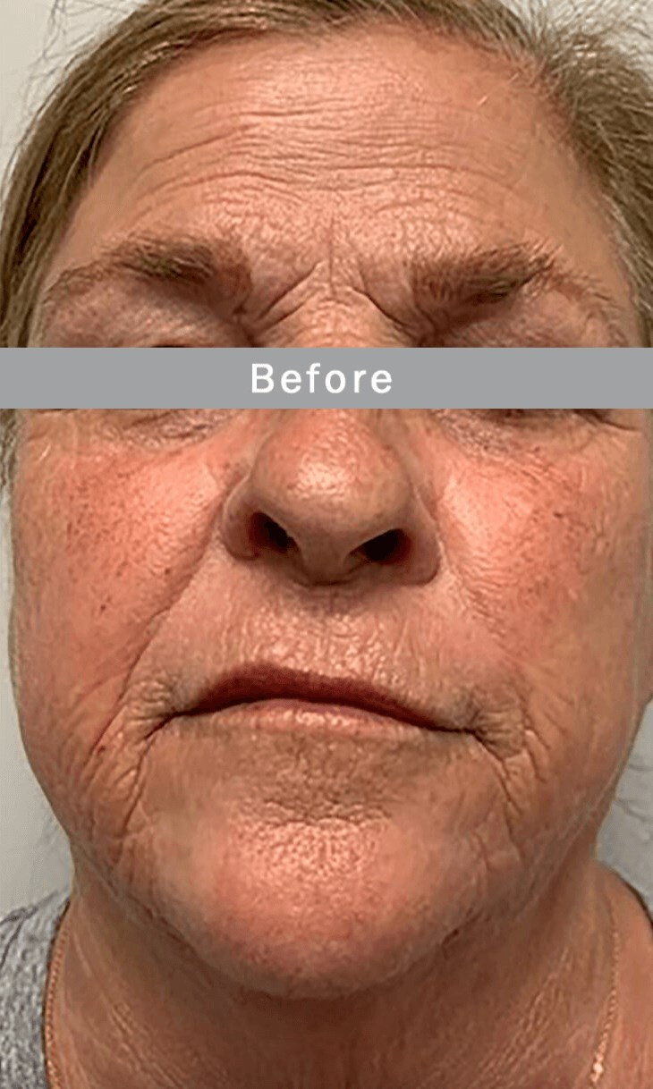 RF Microneedling, Morpheus8 Before