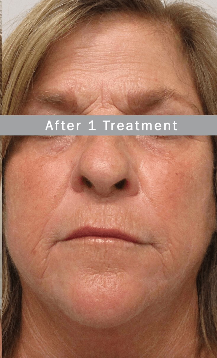 RF Microneedling, Morpheus8 After