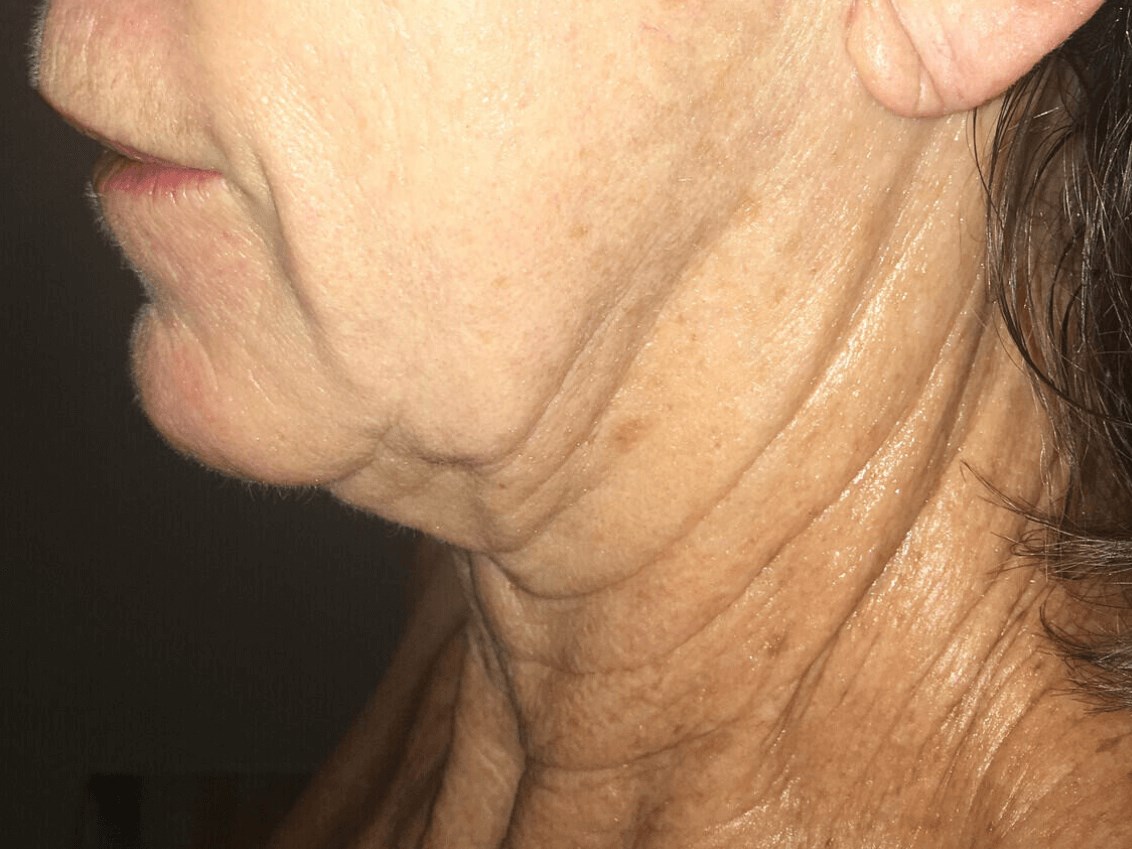 RF Microneedling, Morpheus8 Before