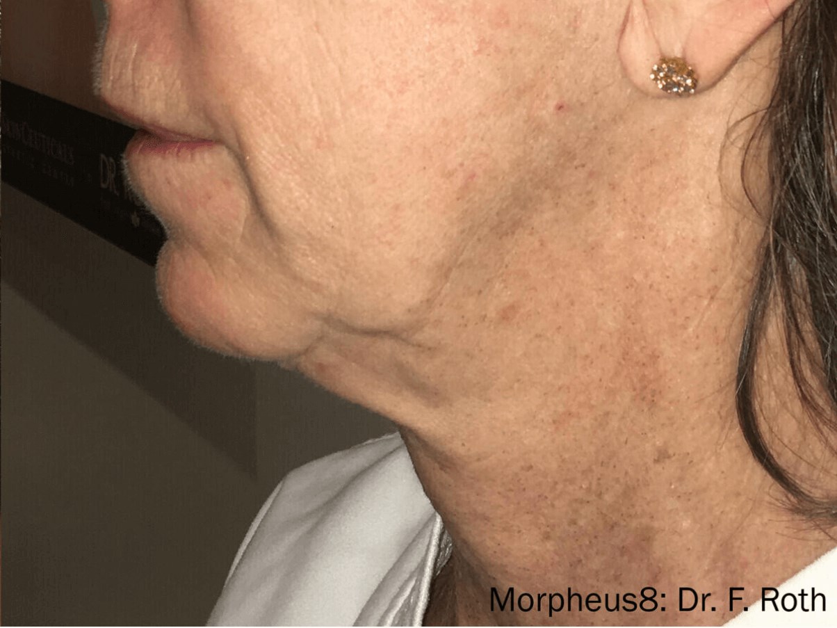 RF Microneedling, Morpheus8 After