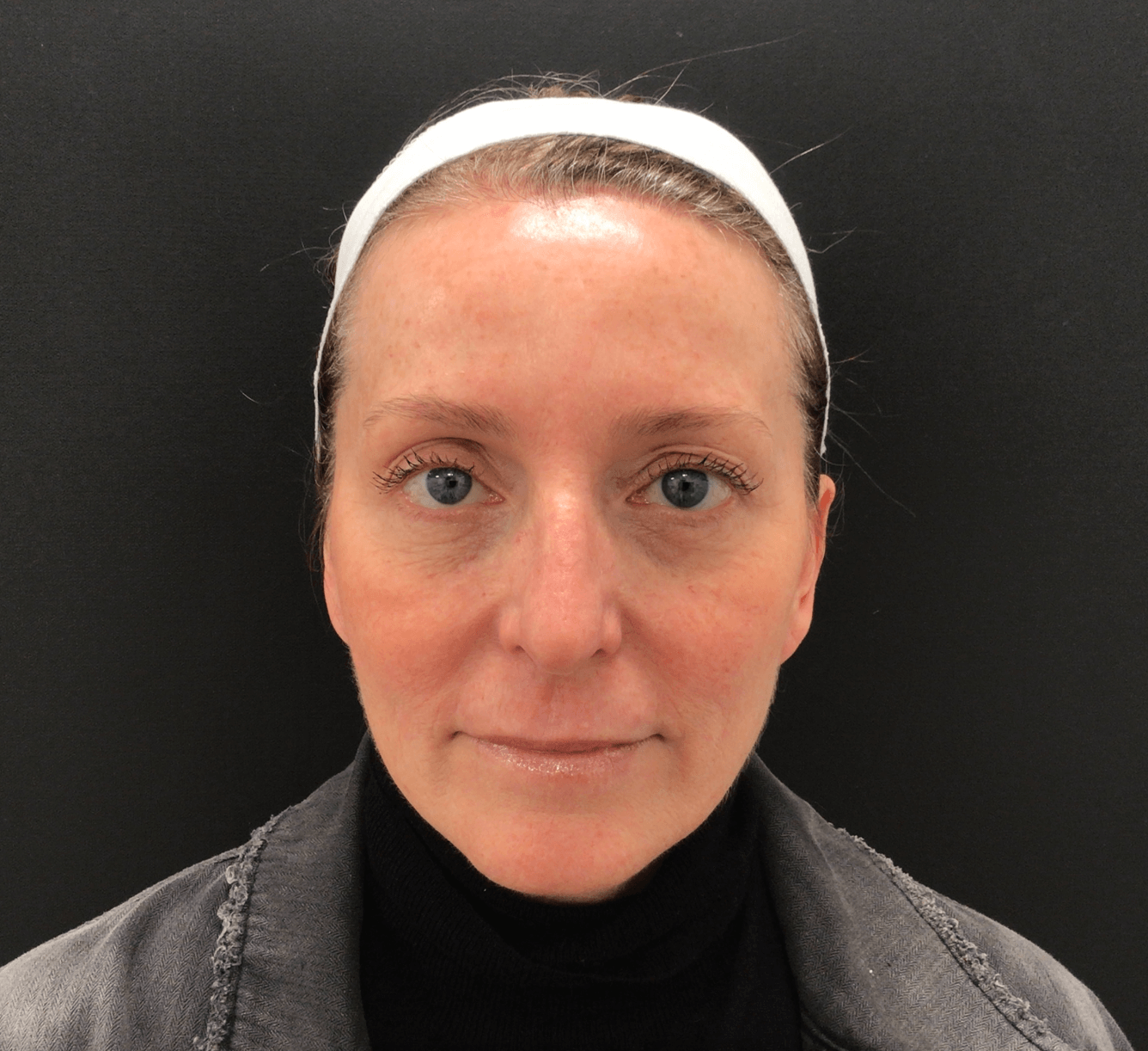 8 Weeks post treatmetn 8 weeks Post Treatment