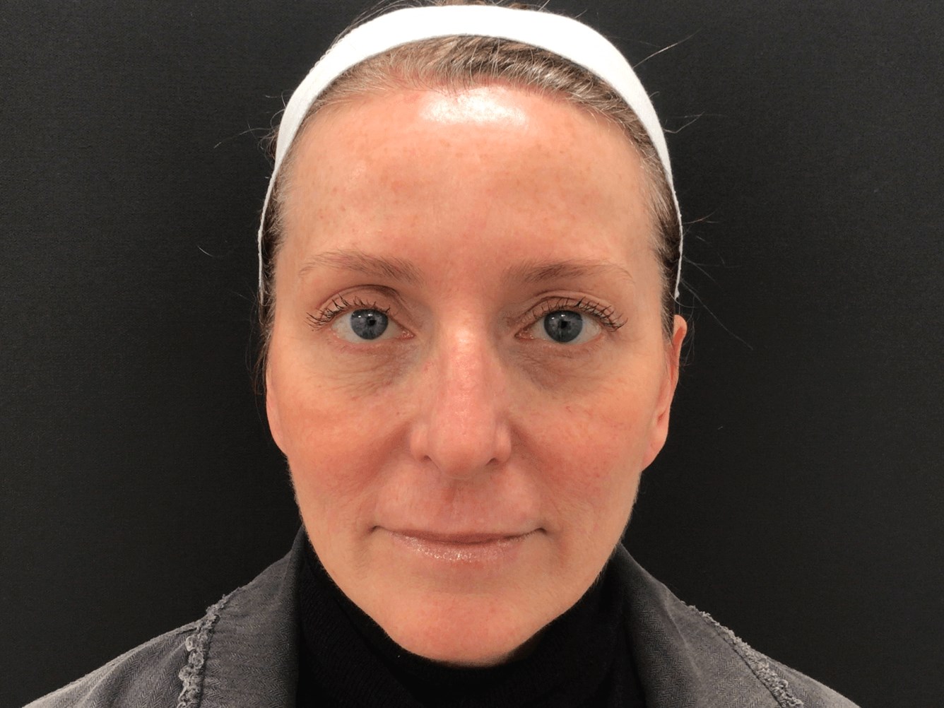 8 Weeks post treatmetn 8 weeks Post Treatment