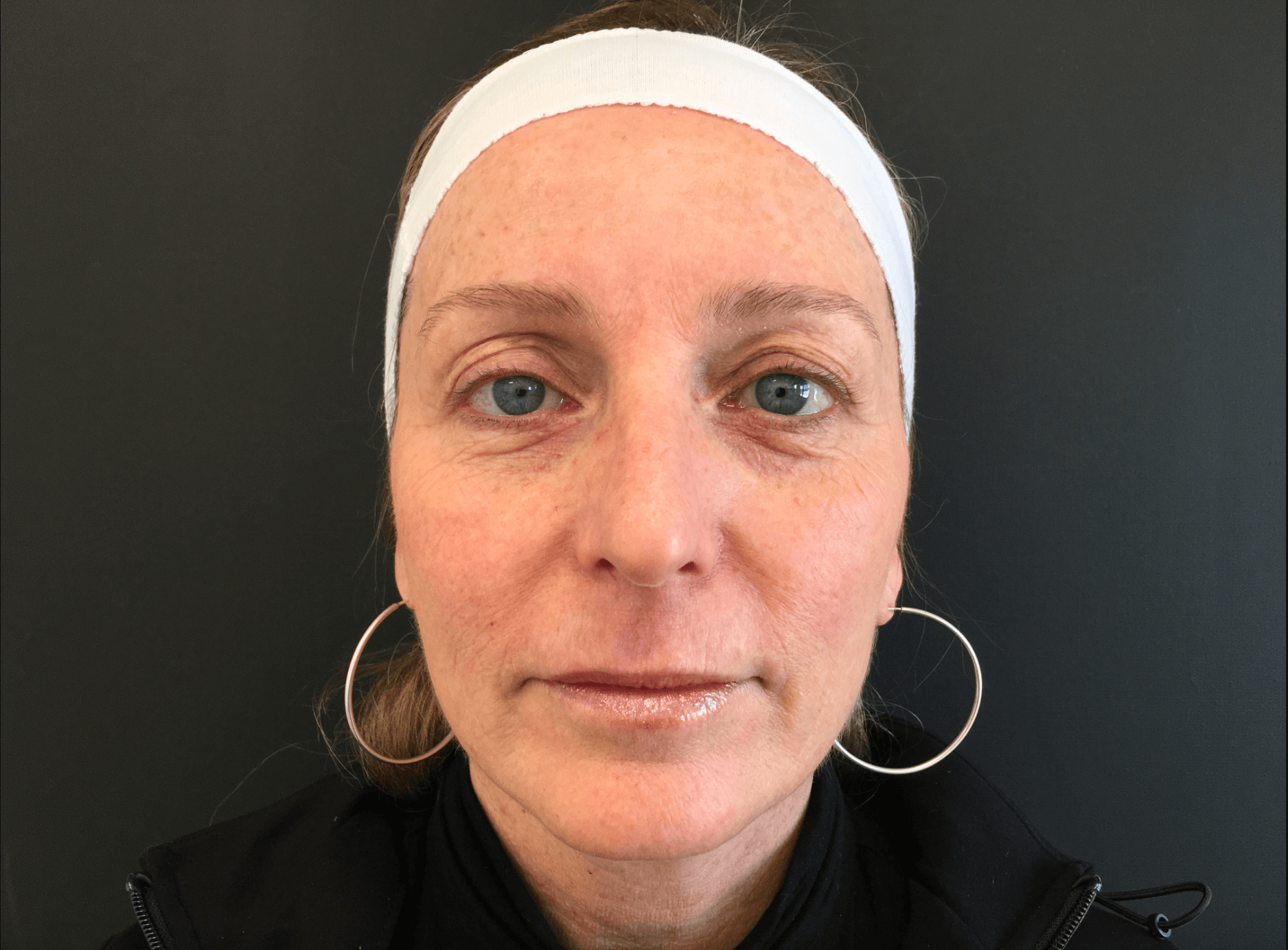 8 Weeks post treatmetn Before Treatment