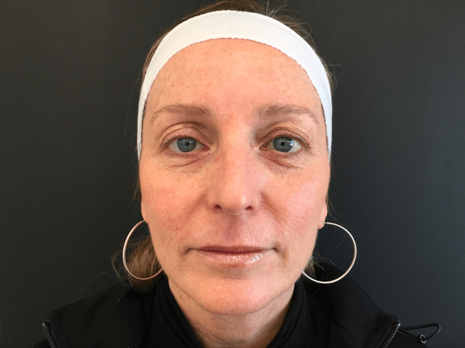 8 Weeks post treatmetn Before Treatment