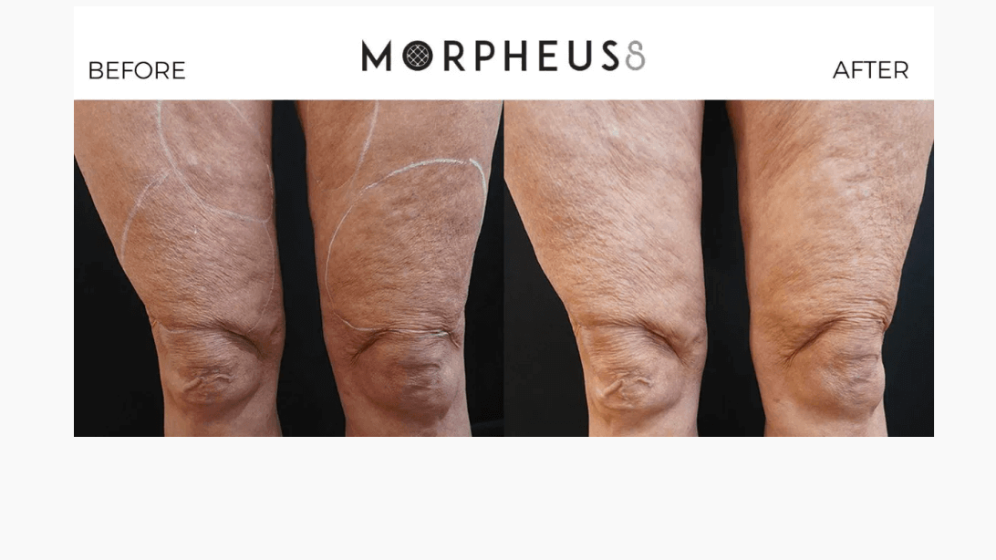 morpheus before and after 