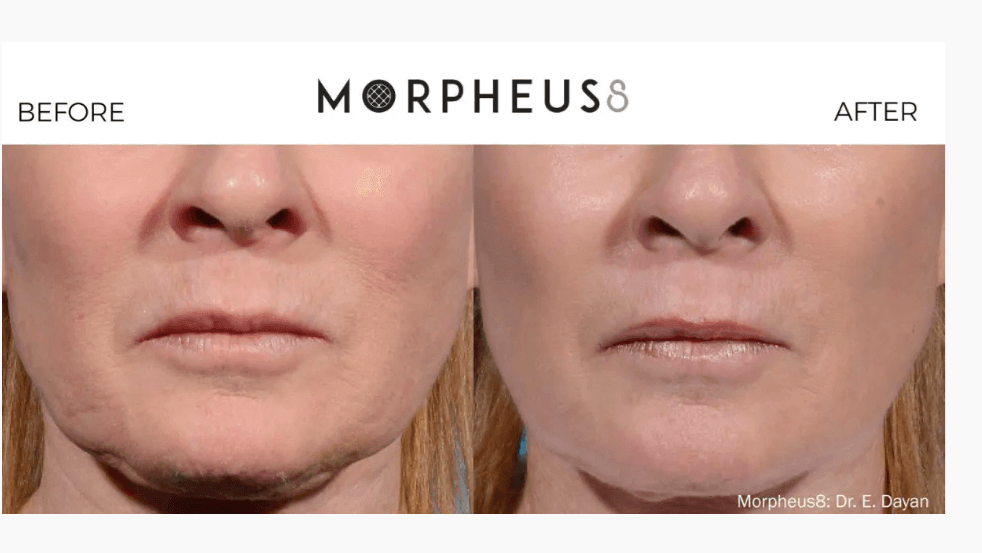 before and after morpheus8