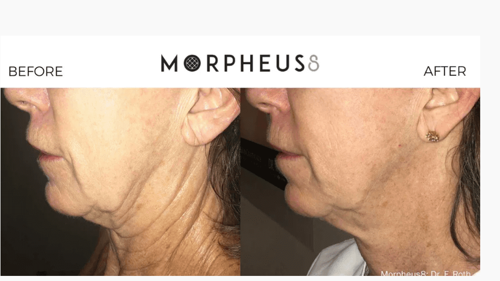 Before and after morpheus 8