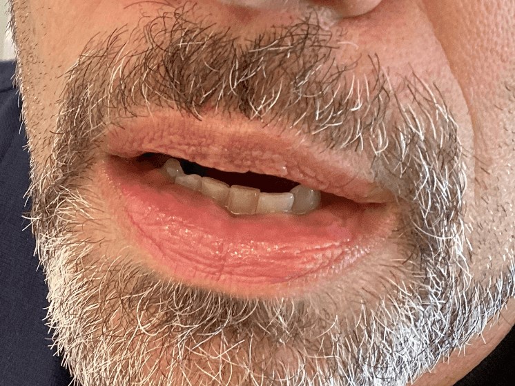 IPL Laser for Venous Lake Lip After