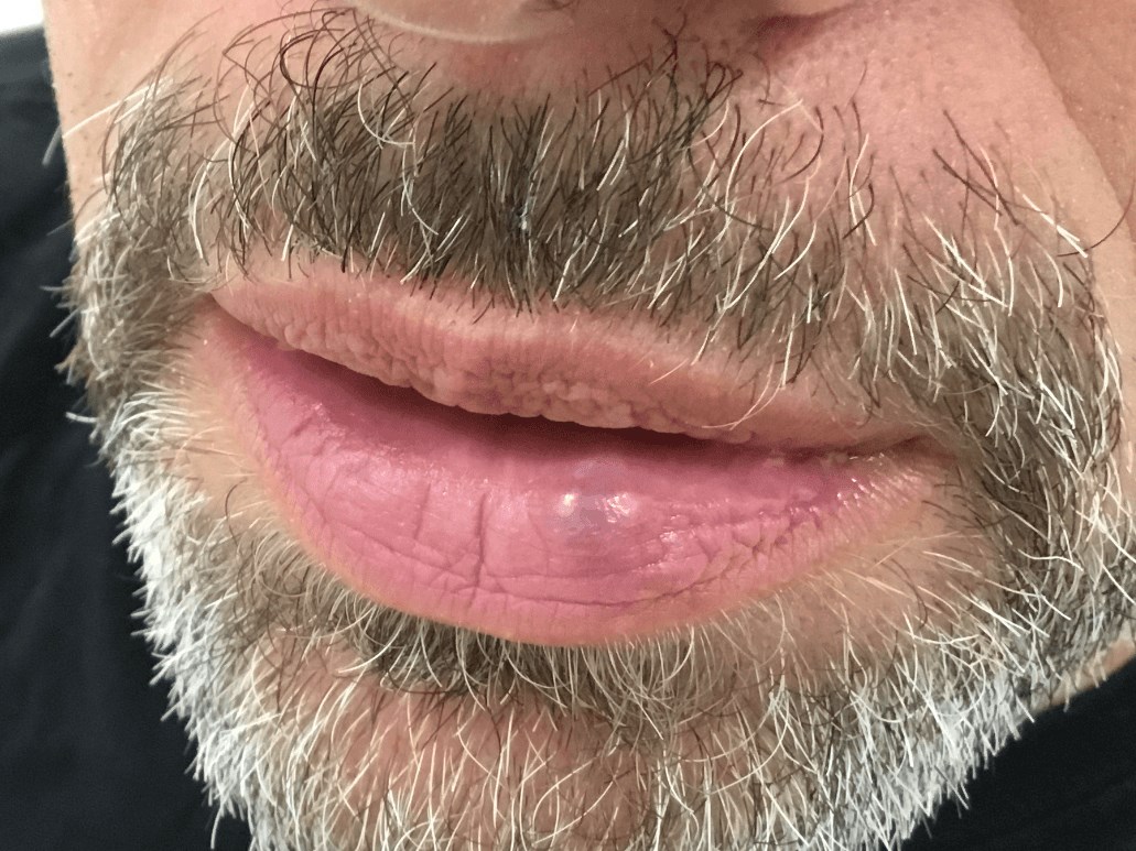IPL Laser for Venous Lake Lip Before