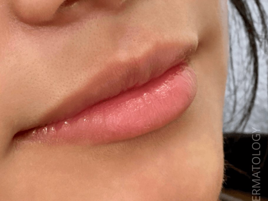 Juvederm Lip Filler Before