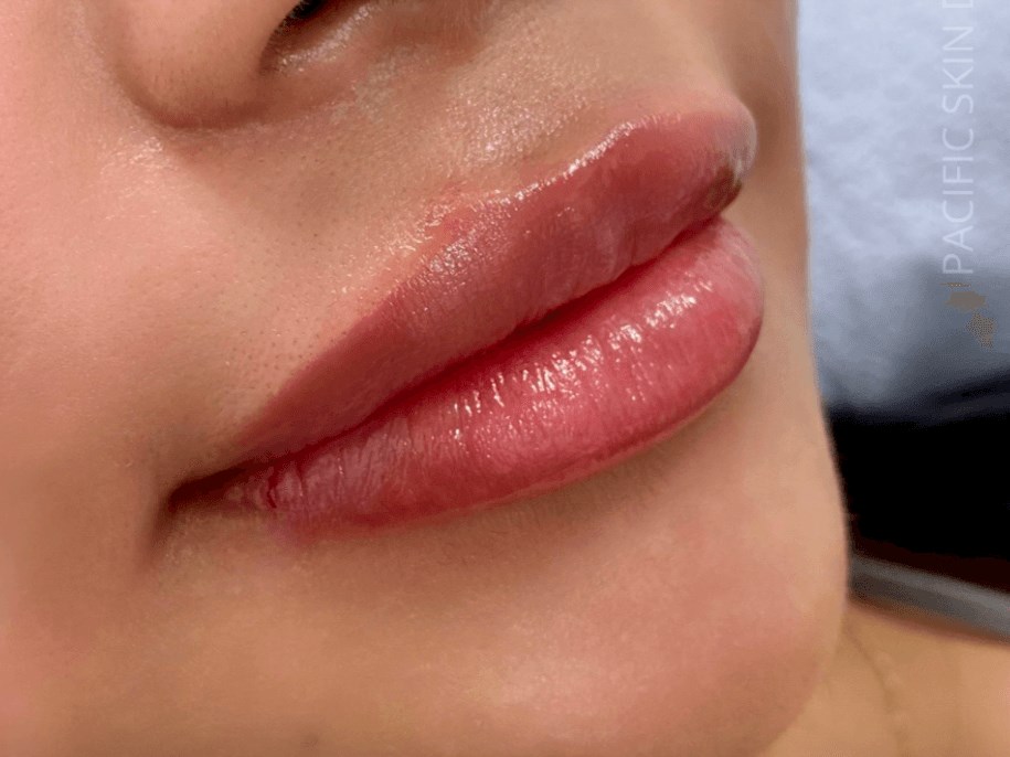 Juvederm Lip Filler After